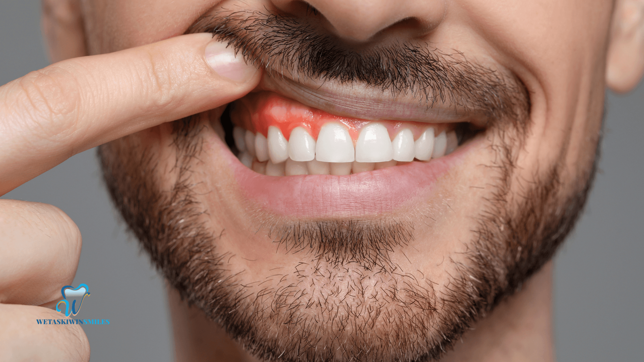 How to Care for Your Gums After Contouring