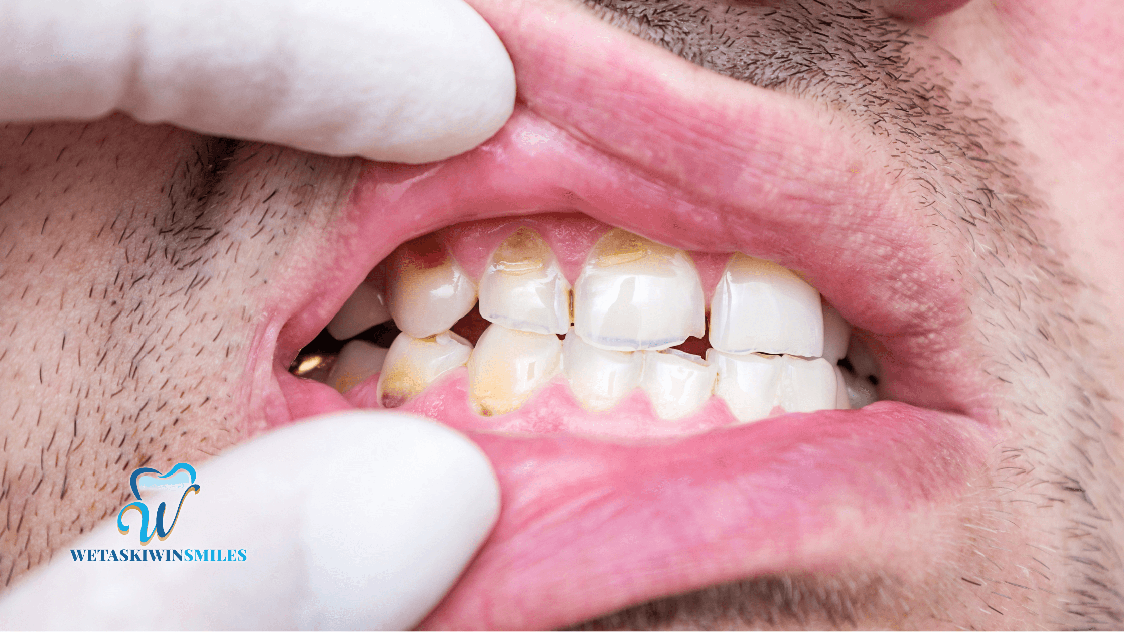 The Science Behind Enamel Erosion and How to Prevent It
