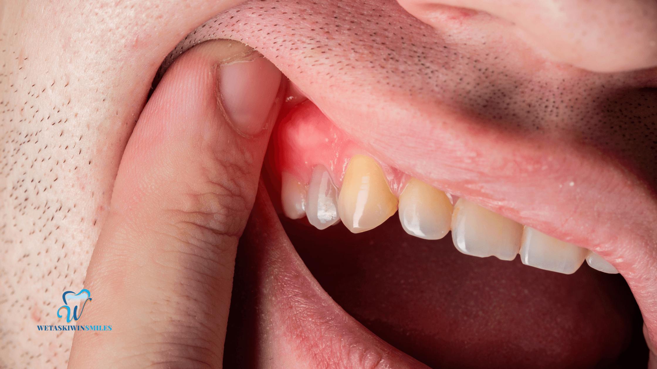 What to Expect During a Gum Contouring Procedure